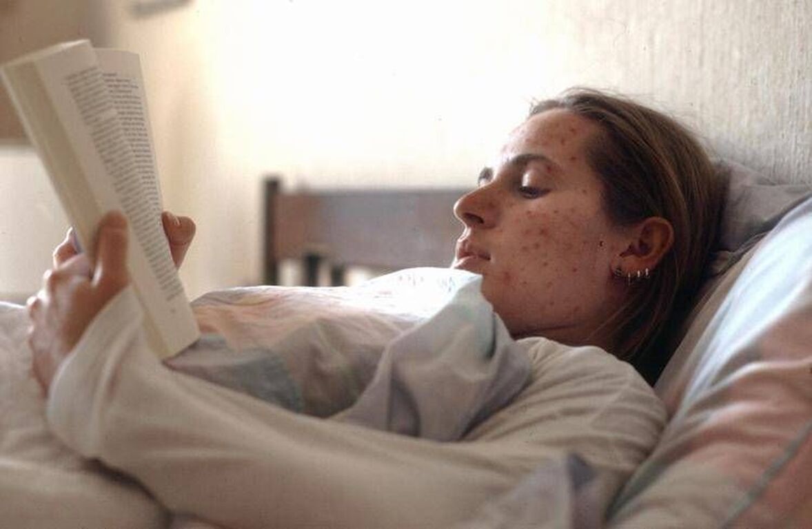 Morbillo, 52 casi a giugno in Italia. Iss: "Verificare status vaccinale prima delle vacanze"