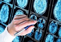 Farmaci, ok Ema a donanemab, neurologi: "Svolta in lotta all'Alzheimer"