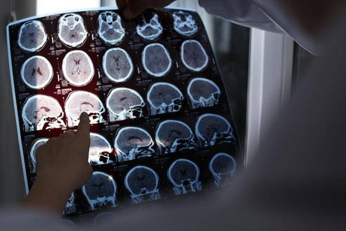 Rallentare l'Alzheimer con il litio, scoperta la 'scintilla' che innesca la patologia?