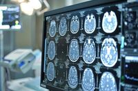 Giornata mondiale dell'Alzheimer, neurologi: "Ora percorsi cura più efficaci e sostenibili"