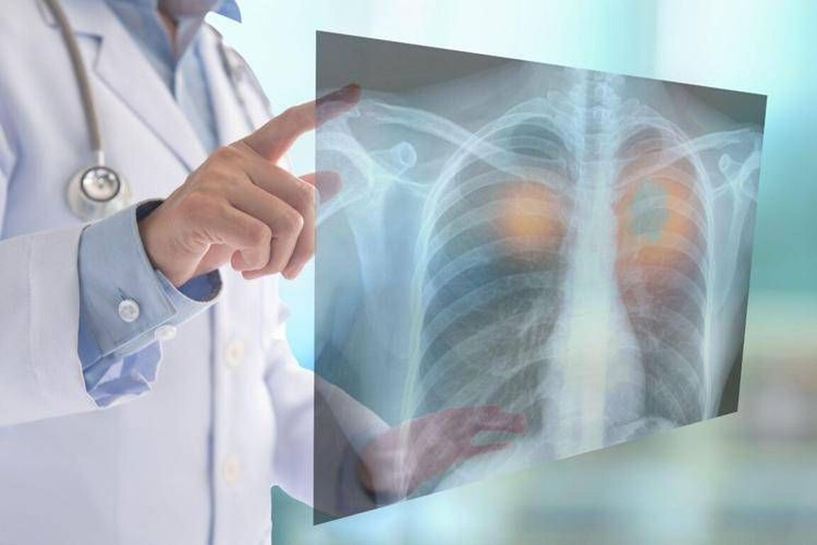 Tumori, nel 2050 i morti cancro supereranno i 18 milioni (+75%): lo studio su Lancet