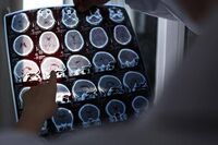 Alzheimer, ok Ue a nuovo farmaco per trattare fasi iniziali malattia