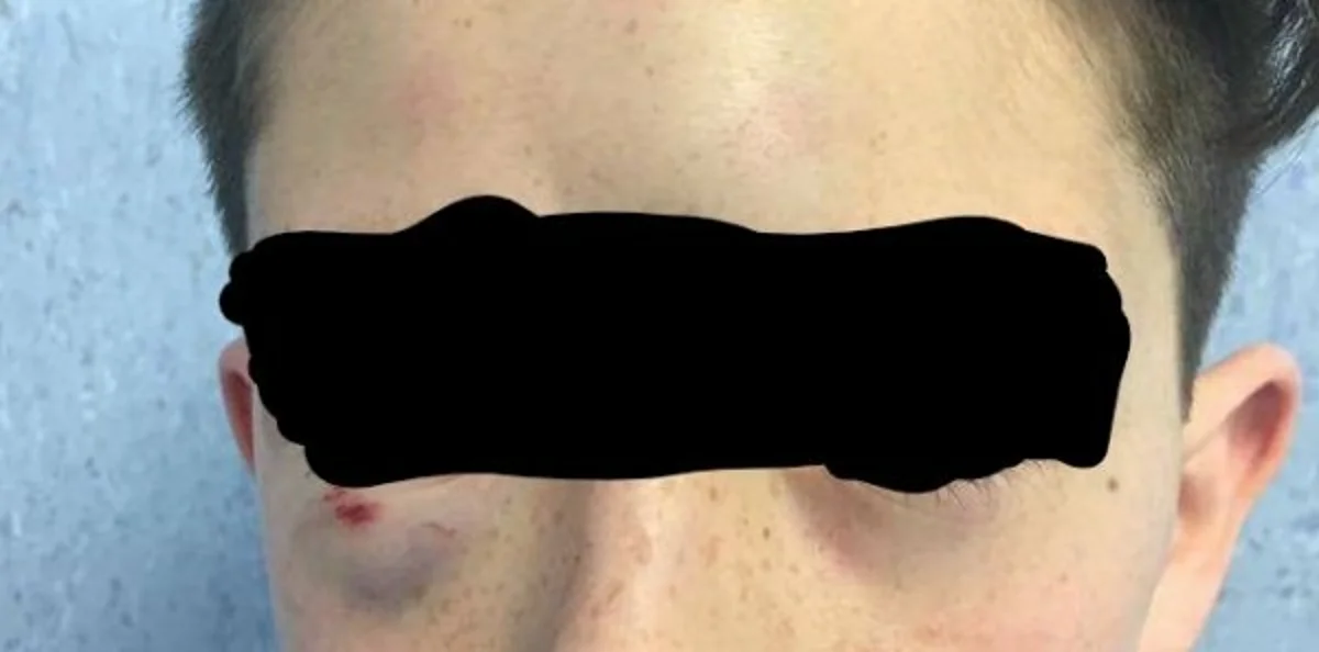 Mugnano (NA) - Figlio pestato dai bulli, foto-denuncia del padre su Facebook