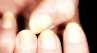Unghie ingiallite per colpa dello smalto? Ecco i rimedi naturali