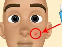 Acne e punti neri? Ecco rimedi fai da te per eliminarli