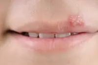 Herpes selle labbra, come curarlo con metodi naturali