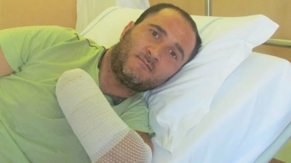 Torre Annunziata - Perse entrambe le mani in un incidente, ora potrà riacquistarne l'uso con due protesi ad alta tecnologia