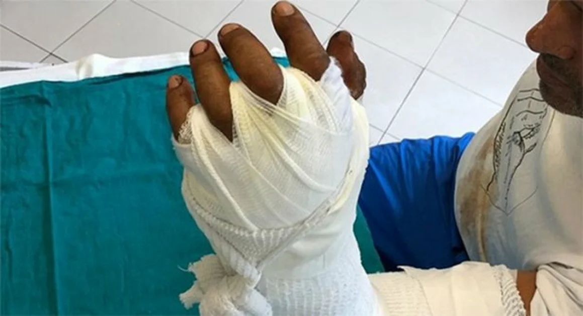 Chirurghi riattaccano mano ad uomo, 11 ore di intervento 