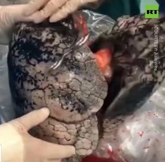 Medico cinese si rifiuta di trapiantare i polmoni ad un paziente: erano carbonizzati dal fumo di tabacco