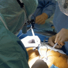 Ospedale Cardarelli, trapianto di fegato in tempo di pandemia: restituita la vita ad un 45enne