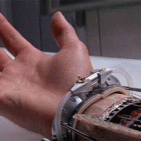 Torre Annunziata - Una mano bionica per Luca. Al via la raccolta fondi