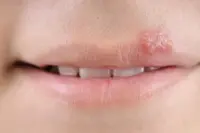 Herpes labiale? Rimedi casalinghi per curarlo 
