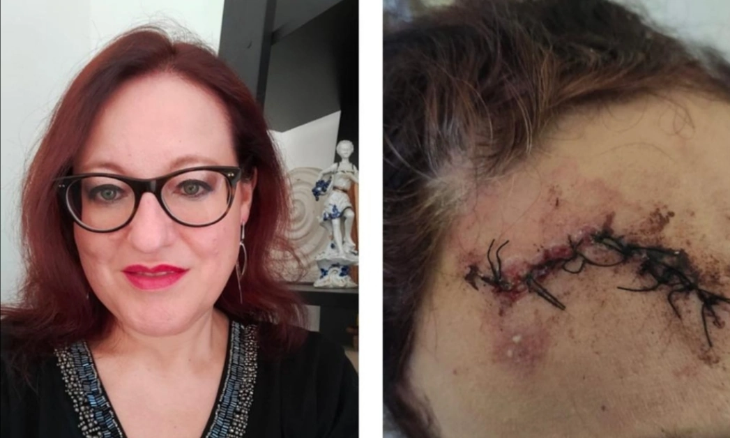 Scooter selvaggio, donna ferita alla Sanità