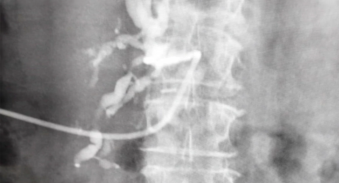 San Leonardo di Castellammare, primo intervento di radiologia interventistica