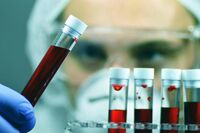 Alzheimer, Sin: "Test del sangue svolta epocale per diagnosi tempestive e cure mirate"