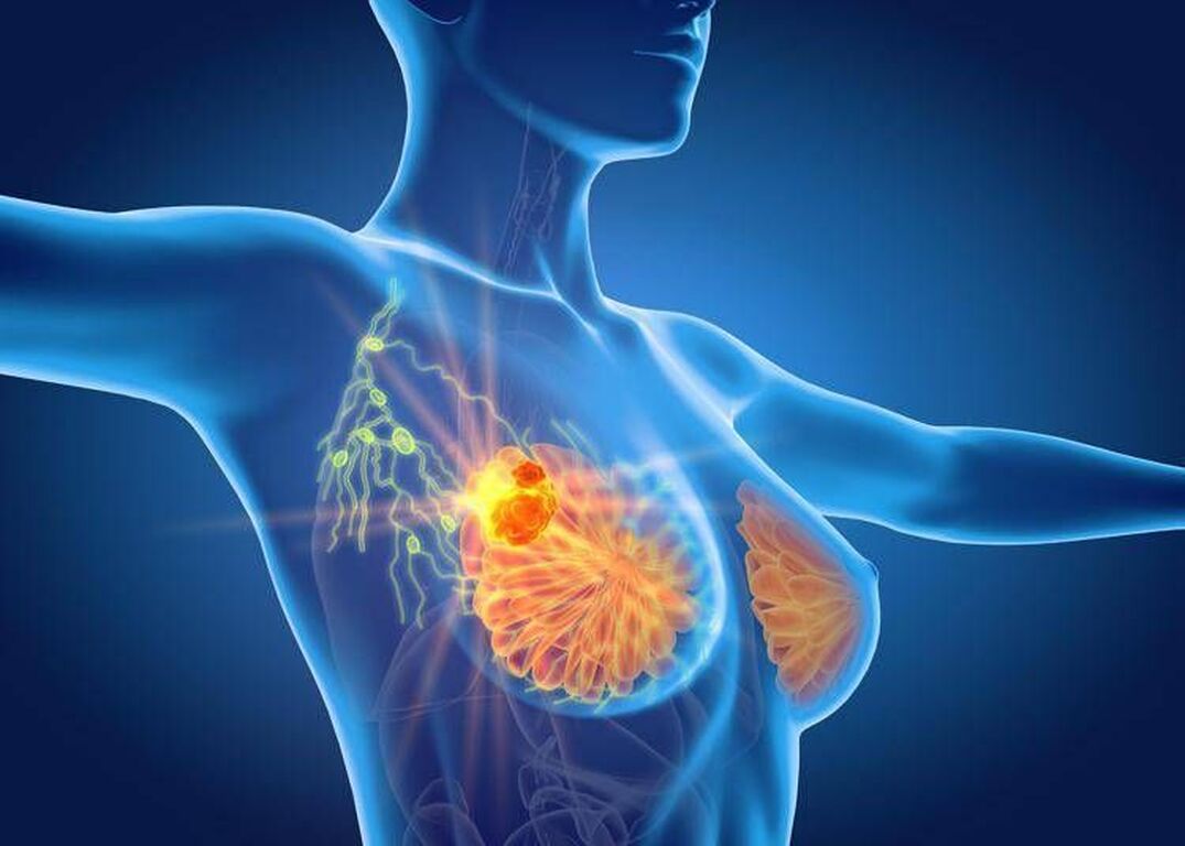 Per cancro seno la cura che arriva dal gelo, Ieo: "Verso un futuro no bisturi"